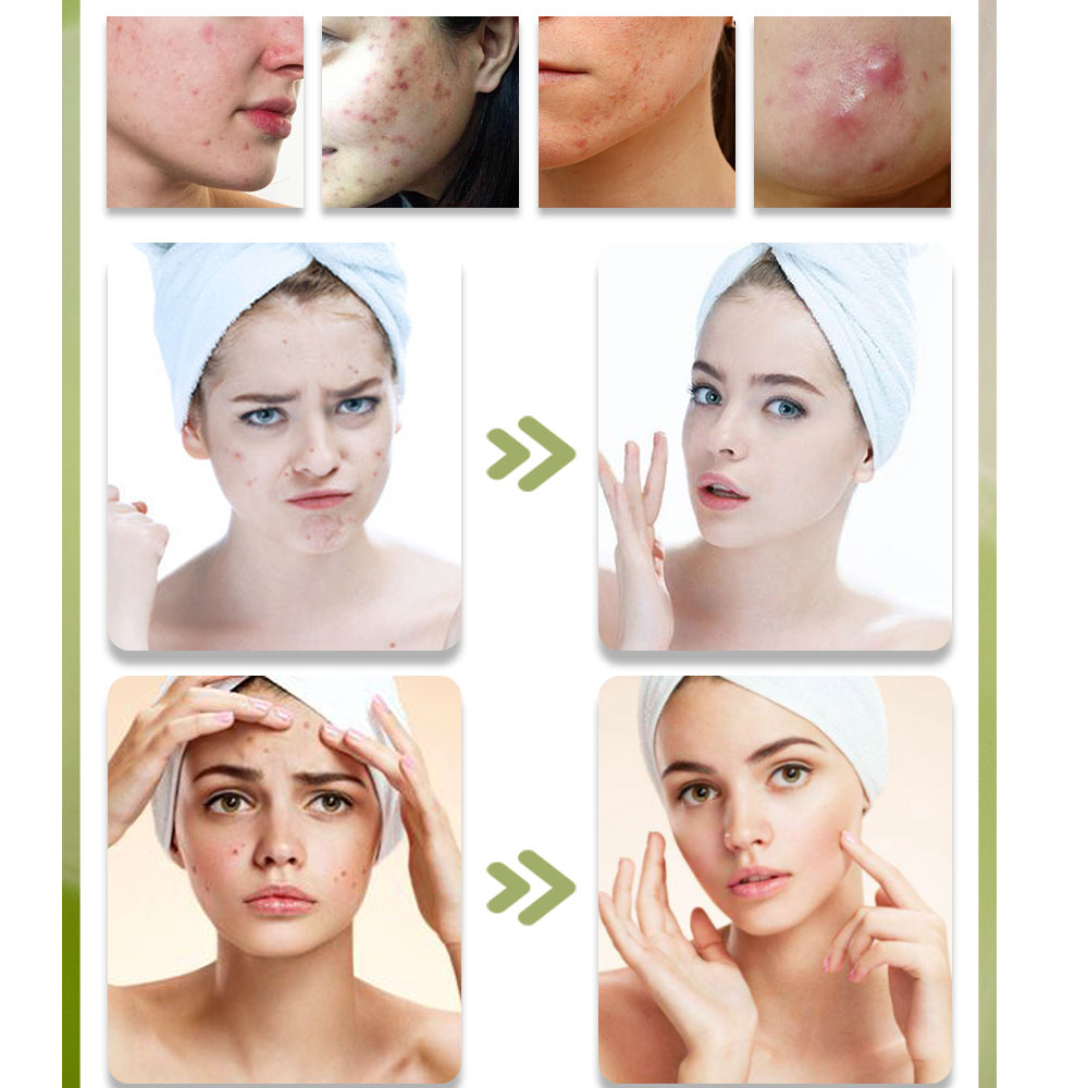 KStims натуральное средство дл – обзор и цена Tea Tree Spot Treatment
